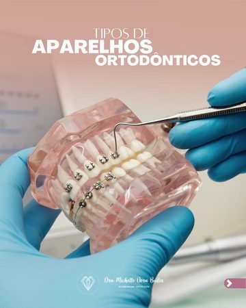 Post: tipos de aparelhos ortodônticos (abre o post no Instagram em nova aba)