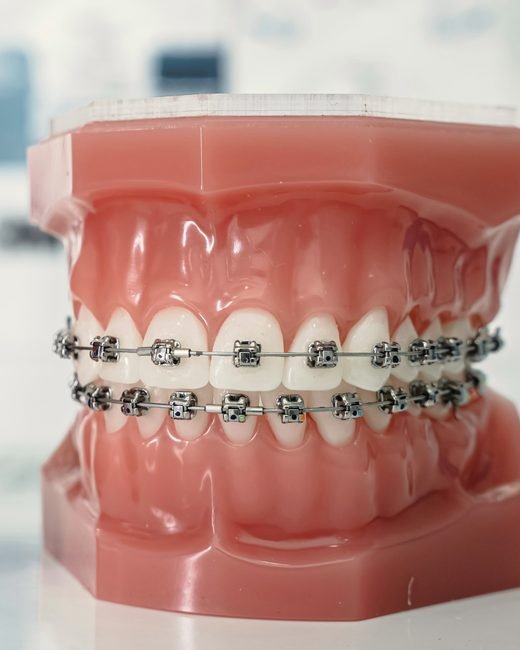 Modelo de arcada dentária com aparelho ortodôntico fixo